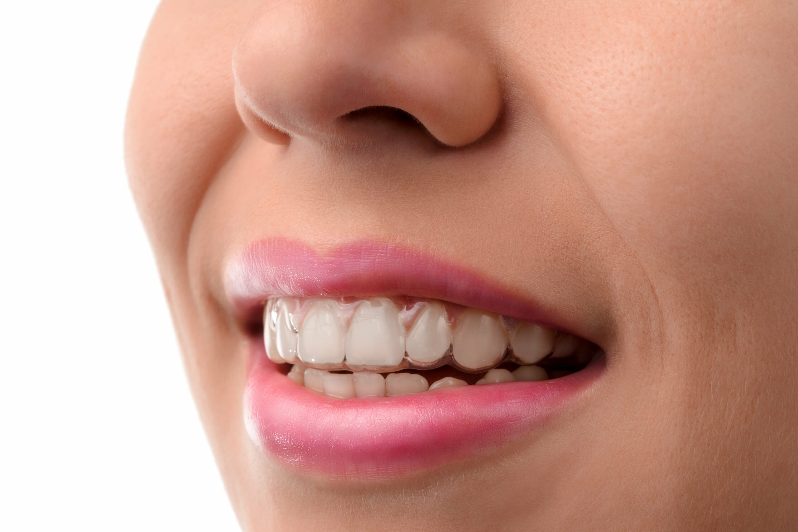 The Invisalign Experience: What Teens Should Expect - Scaffidi