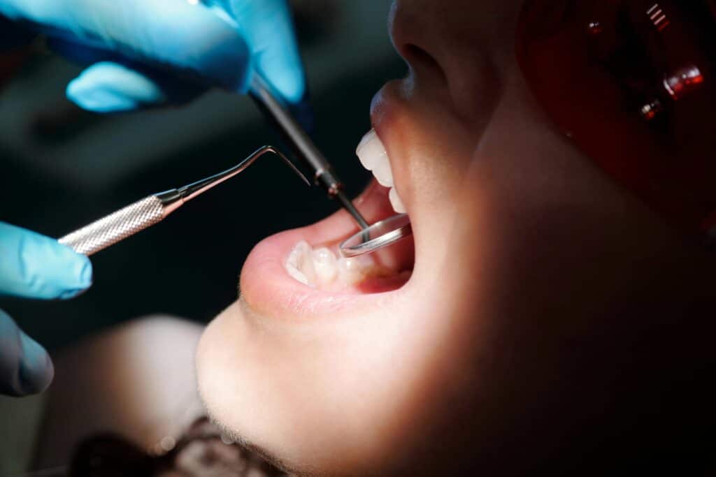 Can You Get Braces With Cavities or Fillings? 2 dentist checking fillings